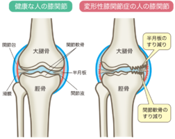 変形性膝関節症で内側の痛みを改善するテーピング
