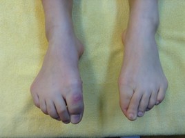 患者さんの症例｜シンスプリントで足の痛みに悩む女子高生