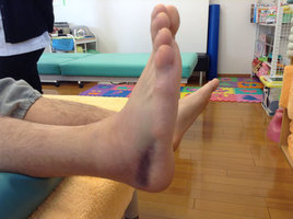 患者さんの症例｜バスケットボールで内出血するほどの足首の捻挫