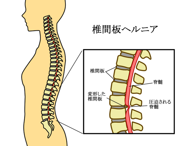 <div>腰が痛くて病院に行ったら椎間板ヘルニアと言われ、症状が悪化してしまわないか心配している方。</div>
<div>以前からヘルニアで腰が痛くて、段々と足も痺れるようになってきた方。</div>
<div></div>
<div>腰痛でお悩みの方にとって、最も代表的なものが椎間板ヘルニアで、統計では3000万人にも上ると言われる腰痛患者の1/3にも上ると言われています。</div>
<div></div>
<div>今回の動画では、ヘルニアとはどんな状態なのか？この腰の痛みはヘルニア？症状チェックと症状悪化を防ぐポイントになる部位、注意しないといけないヘルニアの症状についてまとめました。</div>
<div></div>
<div>以前から腰痛がある、以前にヘルニアと言われて気にしている方のお役に立てると思いますので、是非ご覧ください。</div>
<div></div>
<div></div>
<div></div>
<div>（鍼灸師・あんまマッサージ指圧師・柔道整復師　星野泰隆監修）</div>
<div class="news_area is_type01">
<div class="thumnail">
<div class="image"><img src="/sv_image/w640h640/Q6/E8/Q6E8Glh2pXQNv1KR.jpg" /></div>
<div class="text">
<h3 class="sitetitle"><a href="https://youtu.be/NnllfeOFvcU">腰椎椎間板ヘルニアが飛び出す部位で症状が悪化する？｜後遺症を防ぐためのチェックポイント｜今治市　星野鍼灸接骨院</a></h3>
<p style="margin: 0px; font-style: normal; font-variant-caps: normal; font-stretch: normal; font-size: 13px; line-height: normal; font-family: 'Helvetica Neue'; font-size-adjust: none; font-kerning: auto; font-variant-alternates: normal; font-variant-ligatures: normal; font-variant-numeric: normal; font-variant-east-asian: normal; font-variant-position: normal; font-variant-emoji: normal; font-feature-settings: normal; font-optical-sizing: auto; font-variation-settings: normal;"><span style="text-decoration: underline;">LINE</span><span style="font-style: normal; font-variant-caps: normal; font-stretch: normal; line-height: normal; font-family: 'Hiragino Sans'; font-size-adjust: none; font-kerning: auto; font-variant-alternates: normal; font-variant-ligatures: normal; font-variant-numeric: normal; font-variant-east-asian: normal; font-variant-position: normal; font-variant-emoji: normal; font-feature-settings: normal; font-optical-sizing: auto; font-variation-settings: normal; text-decoration: underline;">にご登録頂くと、無料で健康相談を受け付けています。</span><span style="text-decoration: underline;">★LINE</span><span style="font-style: normal; font-variant-caps: normal; font-stretch: normal; line-height: normal; font-family: 'Hiragino Sans'; font-size-adjust: none; font-kerning: auto; font-variant-alternates: normal; font-variant-ligatures: normal; font-variant-numeric: normal; font-variant-east-asian: normal; font-variant-position: normal; font-variant-emoji: normal; font-feature-settings: normal; font-optical-sizing: auto; font-variation-settings: normal; text-decoration: underline;">登録はこちら</span><span style="text-decoration: underline;">★<a href="https://lin.ee/MGteZSl">https://lin.ee/MGteZSl</a></span></p>
</div>
</div>
</div> ()